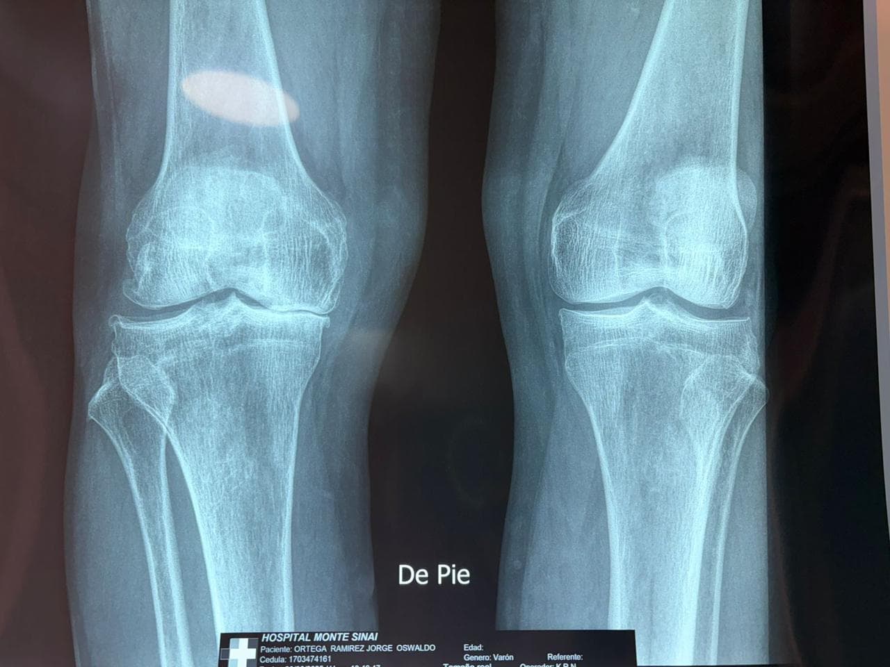 Dolor Crónico y Artrosis